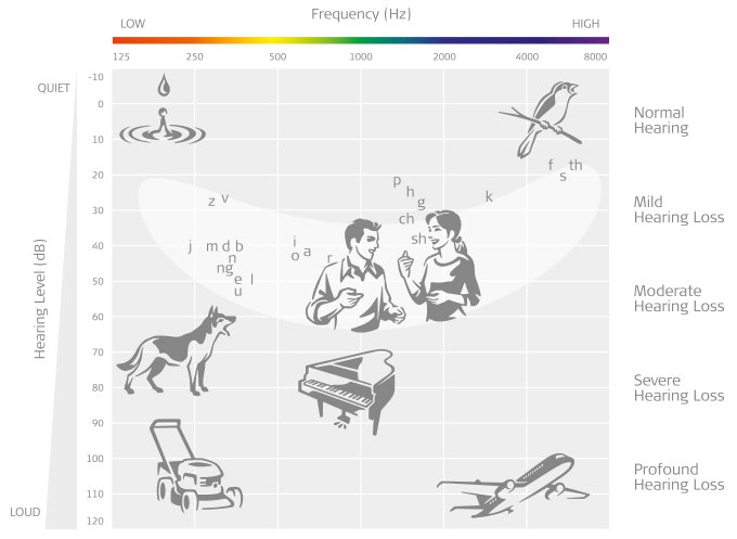 Audiogram showing normal hearing