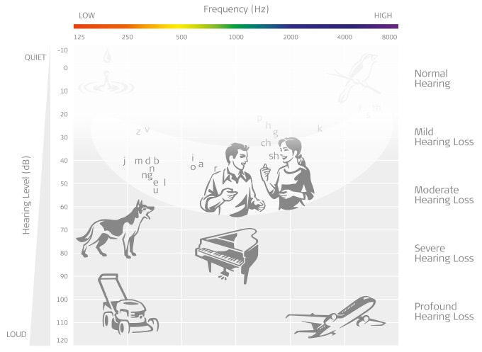 Audiogram showing mild hearing loss