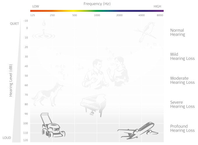 Audiogram showing severe hearing loss