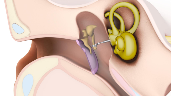 Stapes Prostheses