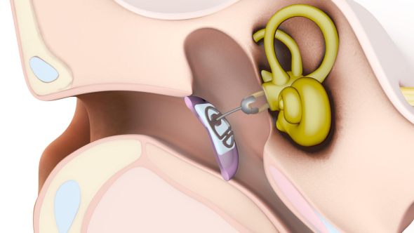 Tympanoplasty Prostheses