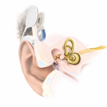 Anatomy Cochlear Implant