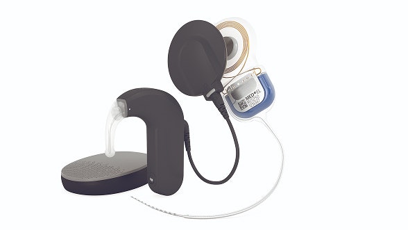 Cochlear Implant System