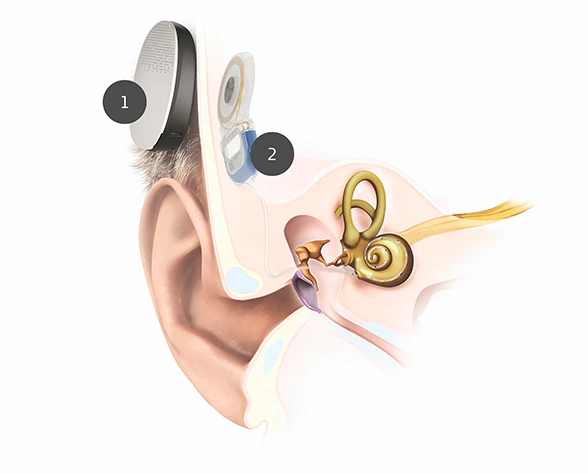 Anatomy image of an ear with a SYNCHRONY 2 implant and a RONDO 3 audio processor.