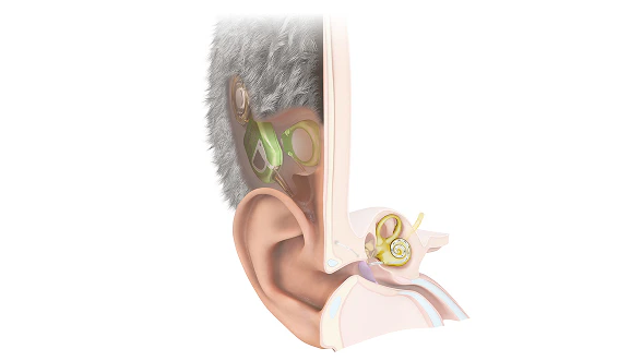 anatomy image of the TICI